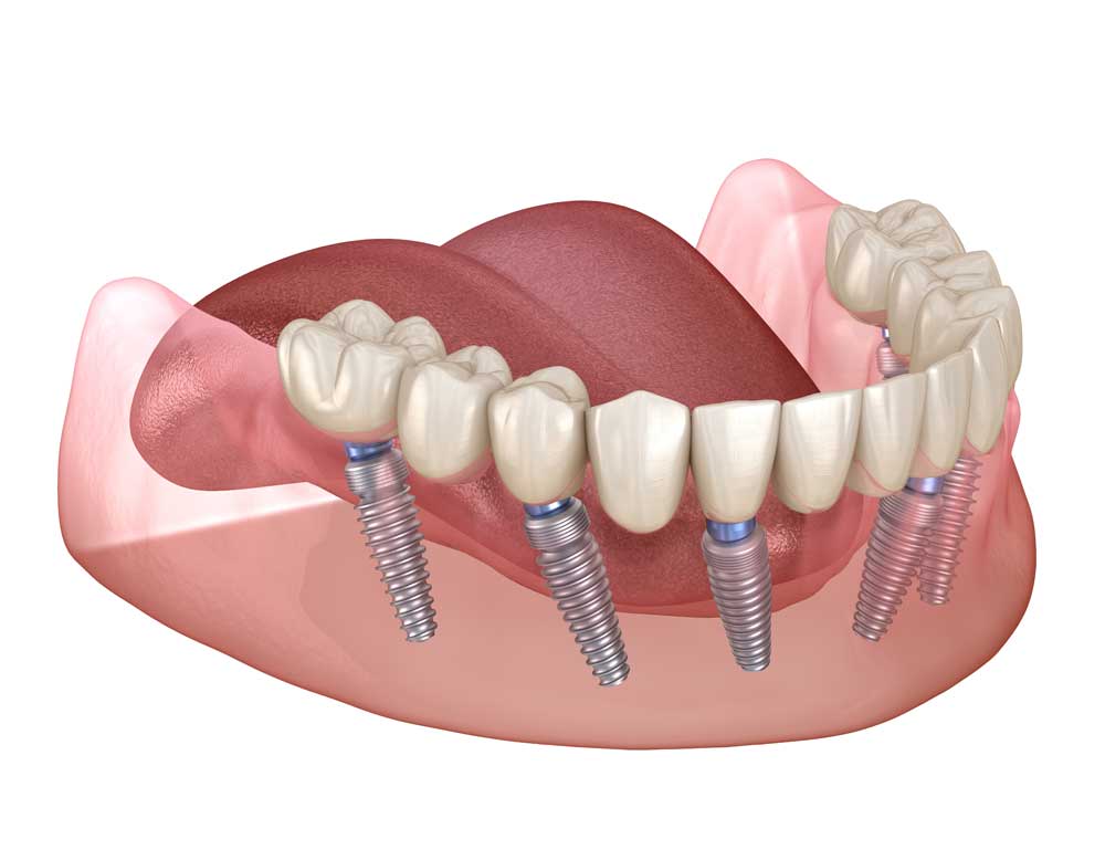 full mouth dental implants via all on 4 implants