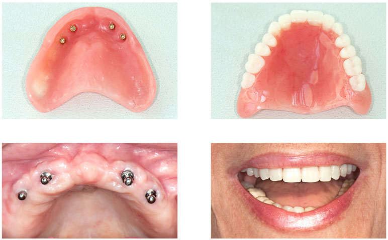 dental implants bell ca