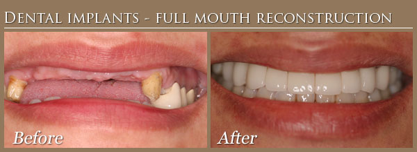 Dental Implant Full Mouth Reconstruction 2