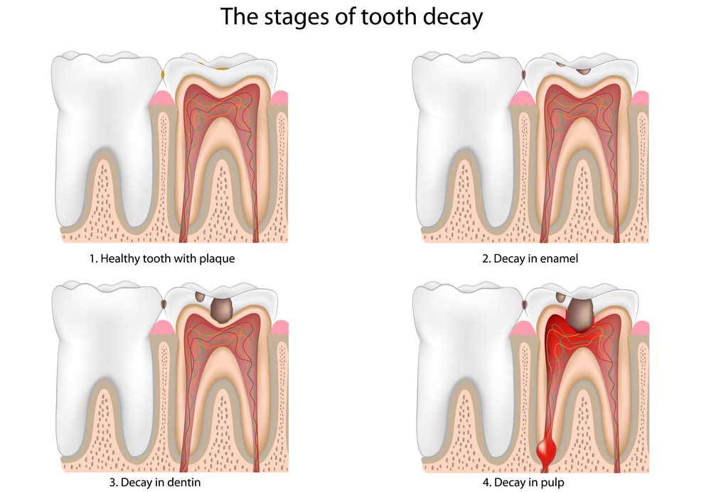tooth decay treatment east los angeles