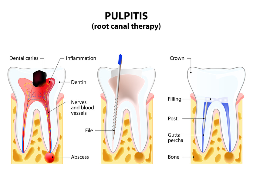 root canal treatment East Los Angeles
