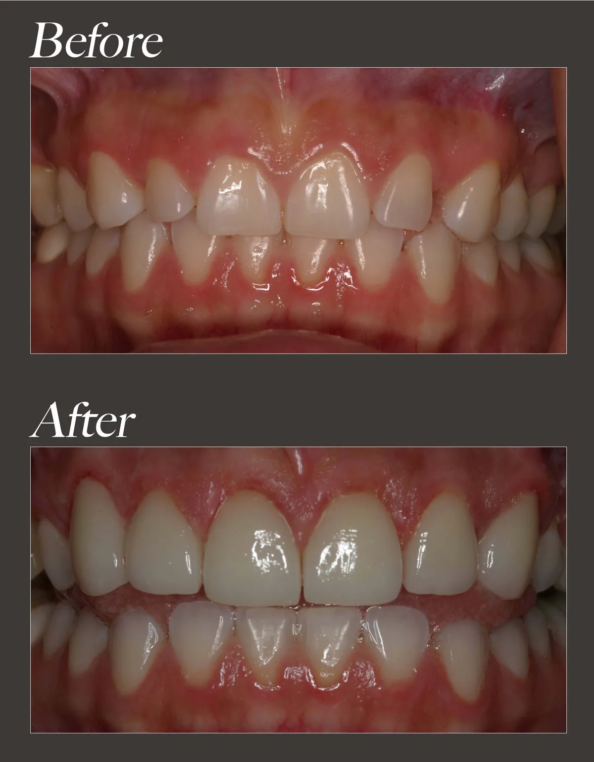 Gum contouring before and after case 2