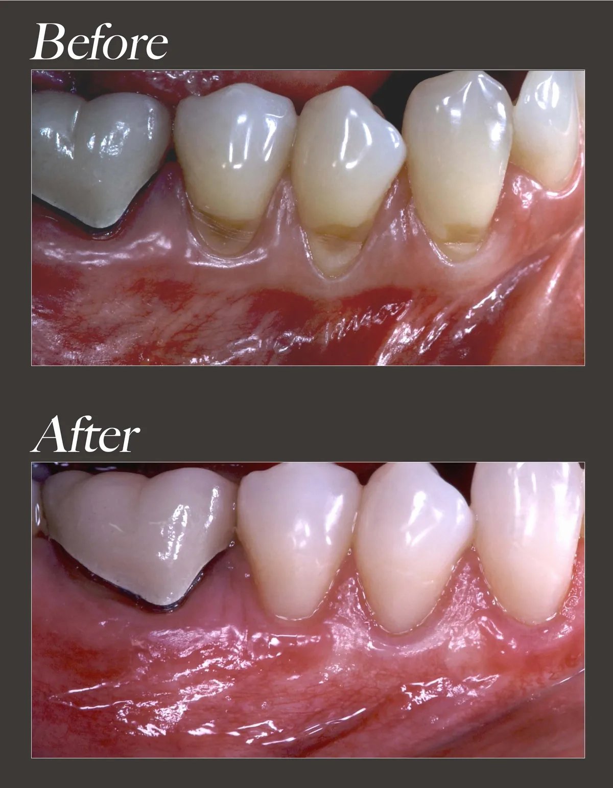 Gum recession treatment before and after