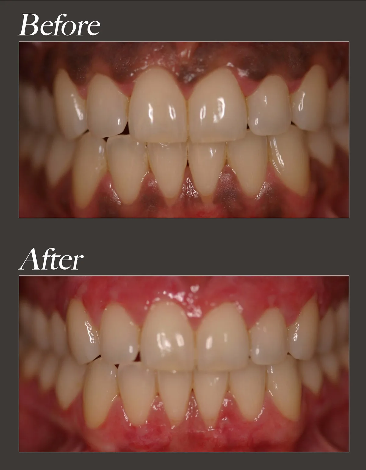 Gum whitening before and after case 1
