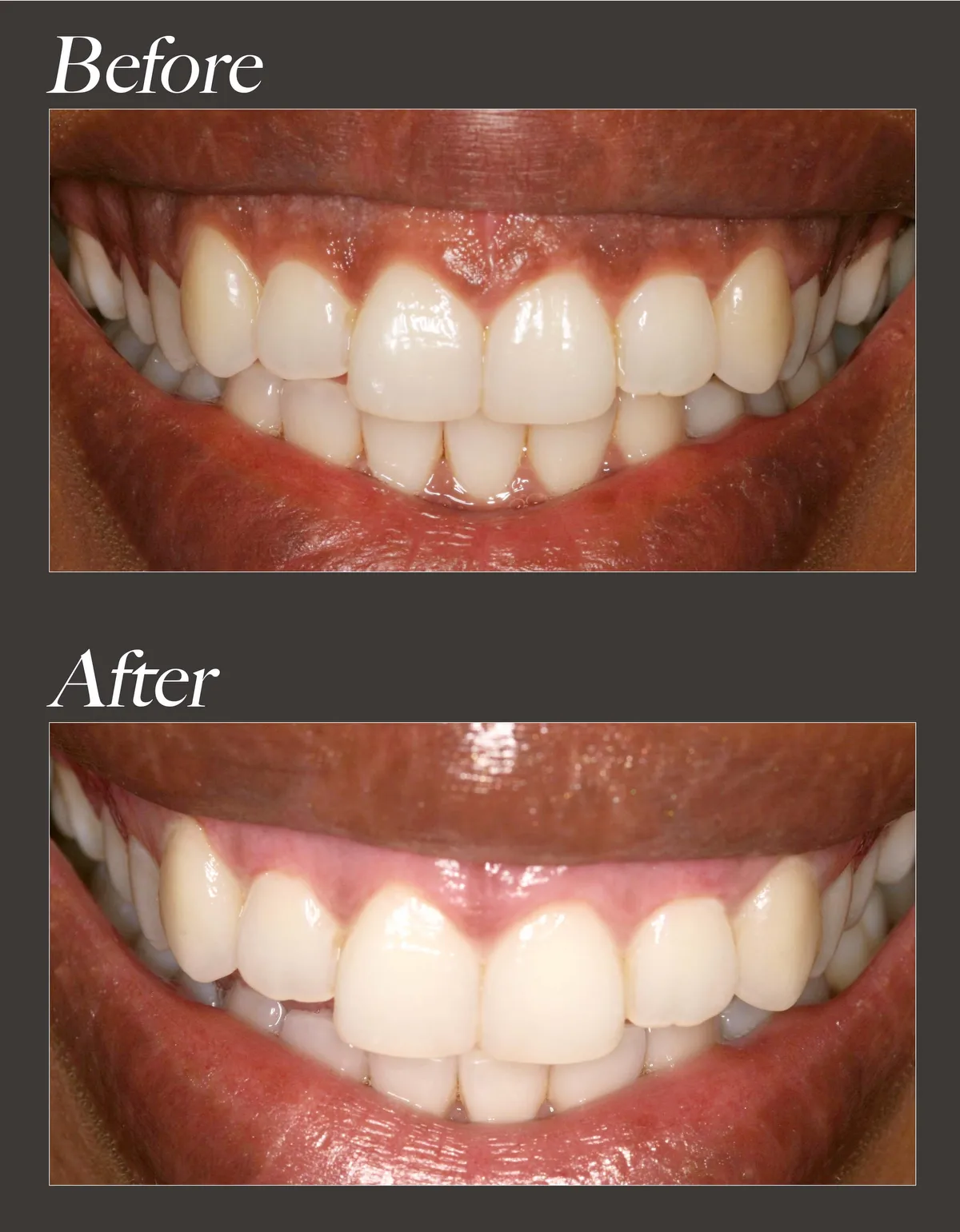 Gum whitening before and after case 2