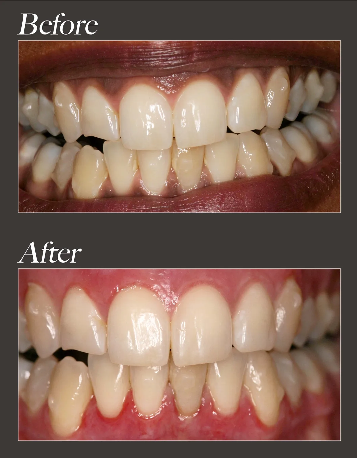 Gum whitening before and after case 3