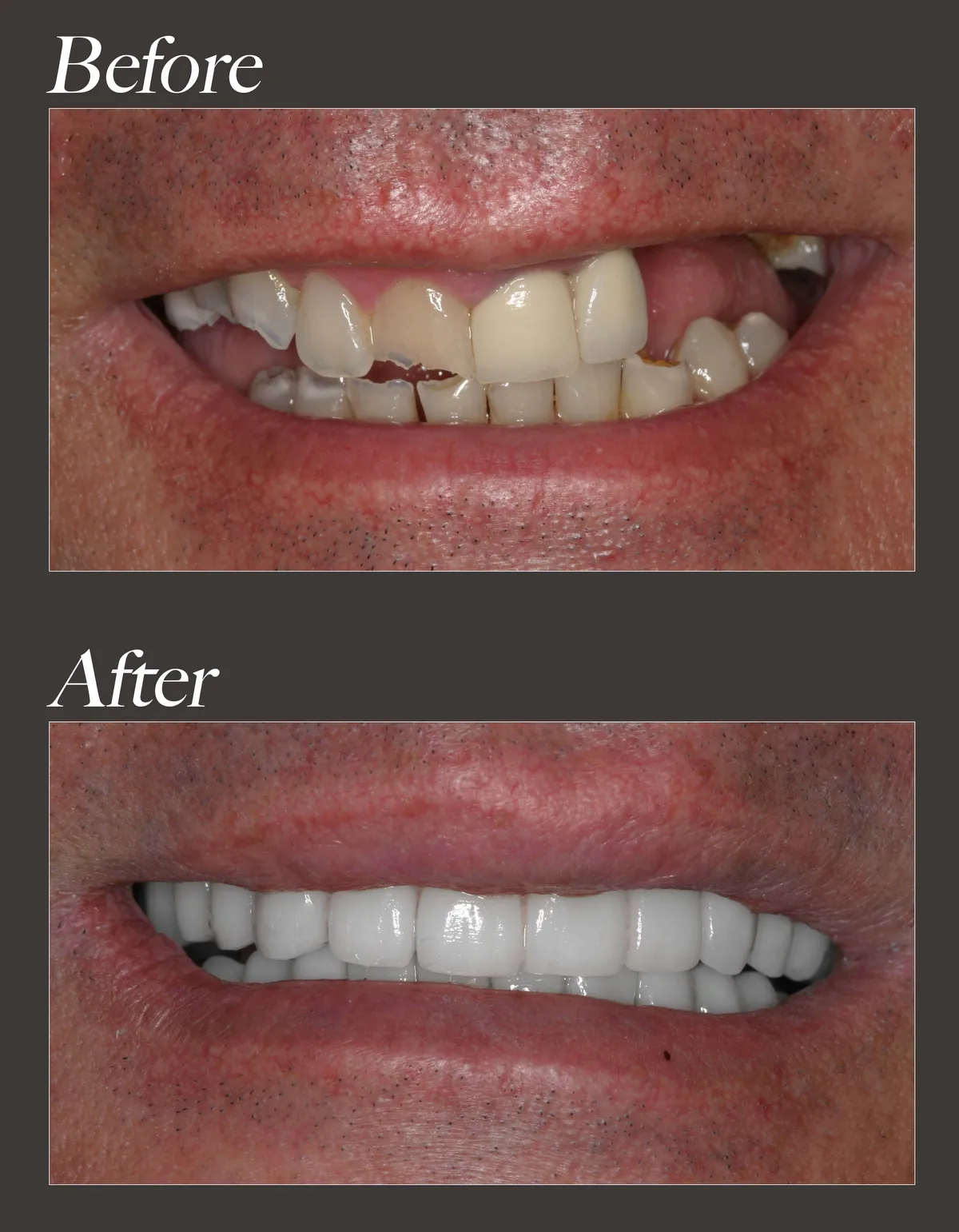 Dental implant before and after case 1