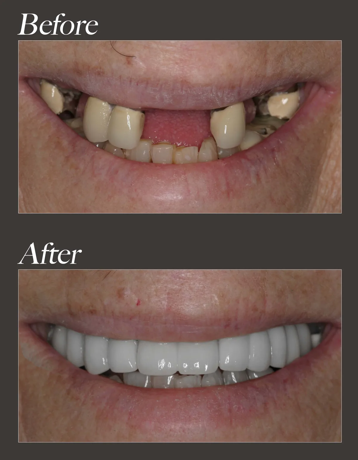 Dental implant before and after case 2