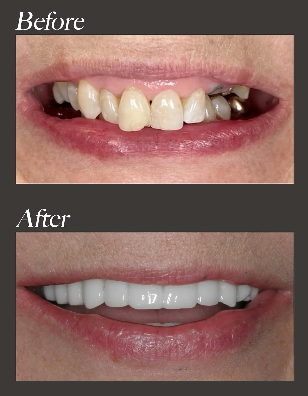 Dental implant before and after case 3