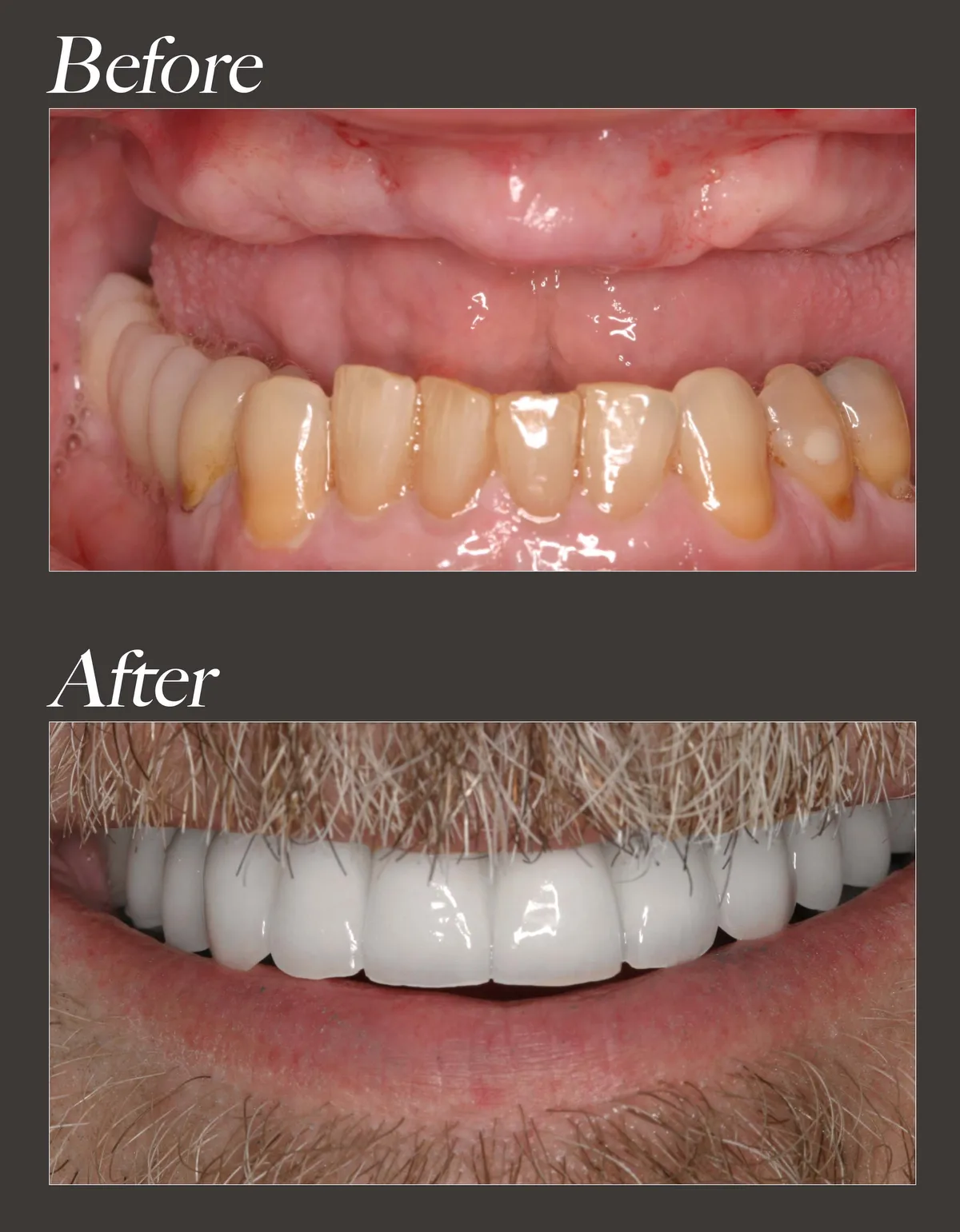 Full arch dental implant before and after case 1