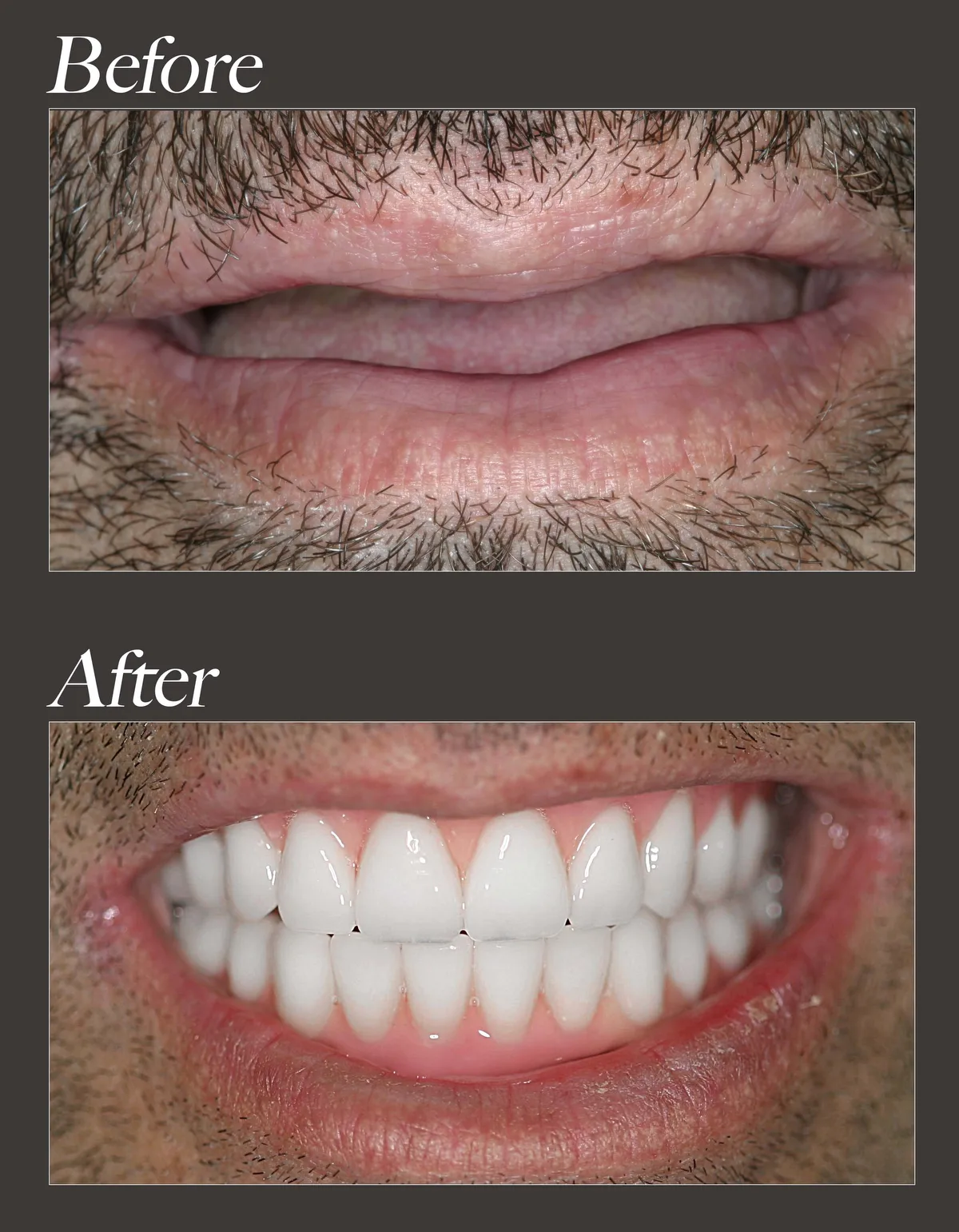 Full arch dental implant before and after case 2