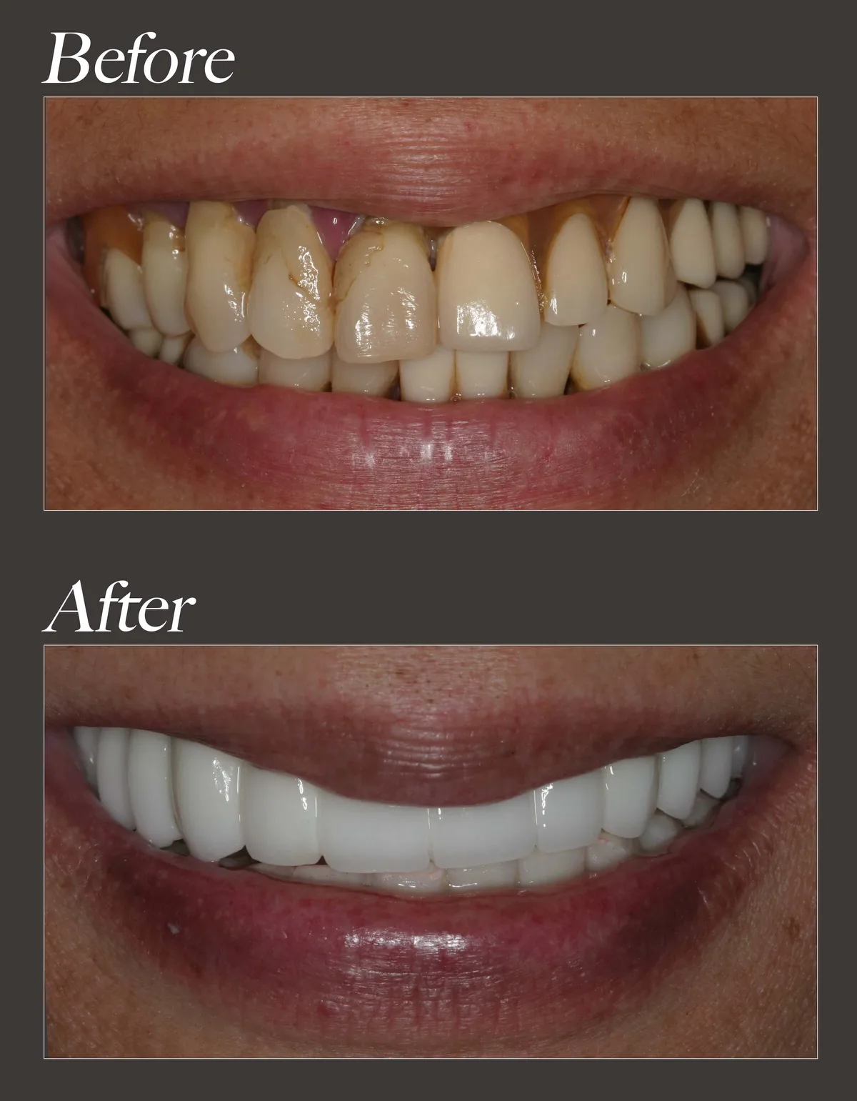 Full arch dental implant before and after case 3