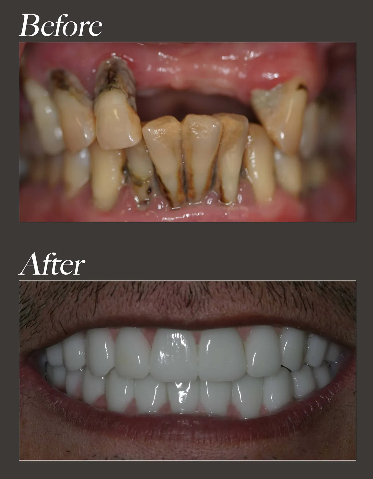 All-on-4 dental implant before and after case 1