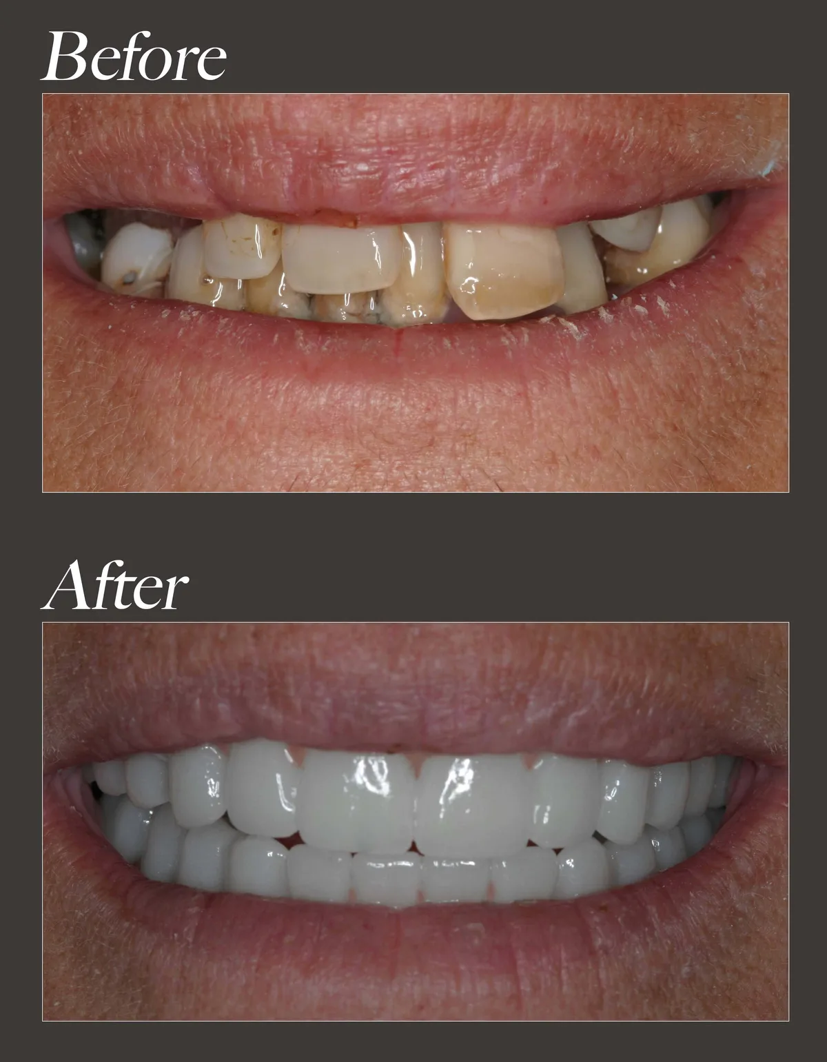 All-on-4 dental implant before and after case 2