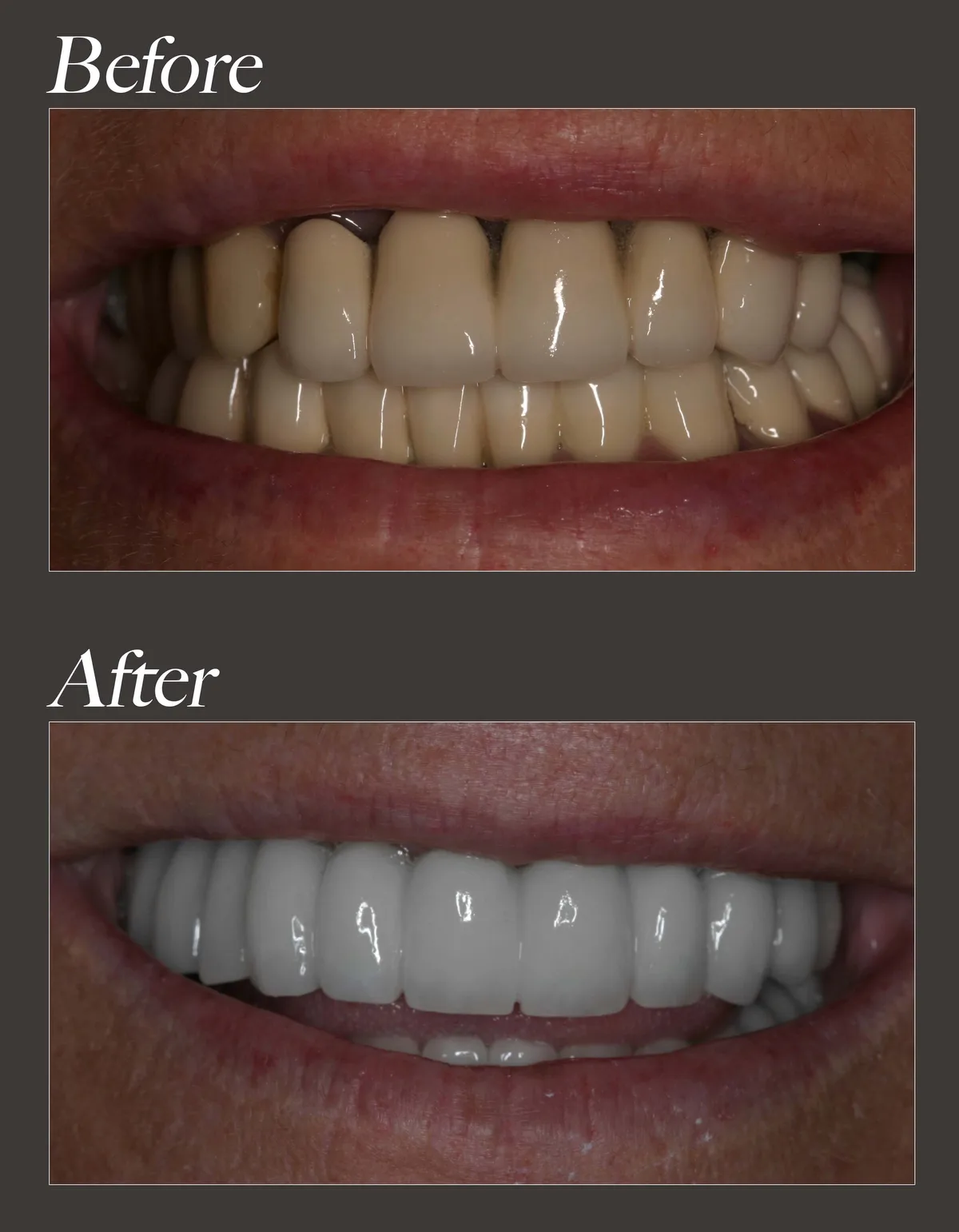 All-on-4 dental implant before and after case 3