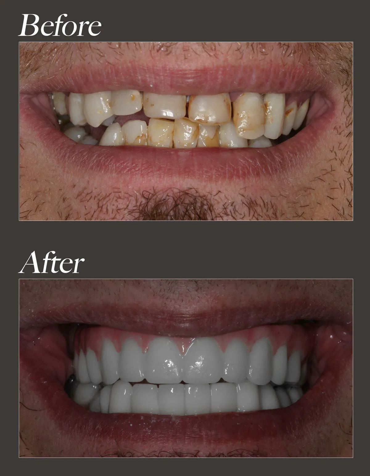 All-on-6 dental implant before and after case 1
