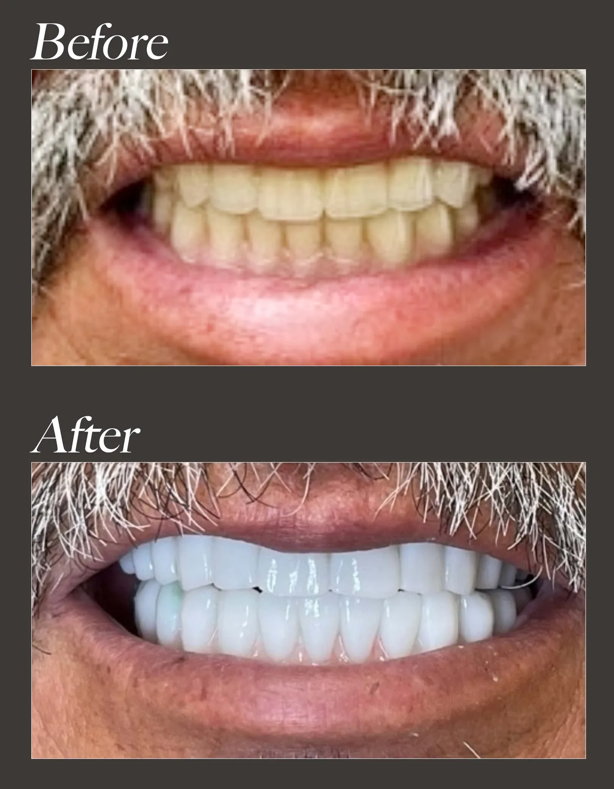All-on-6 dental implant before and after case 2