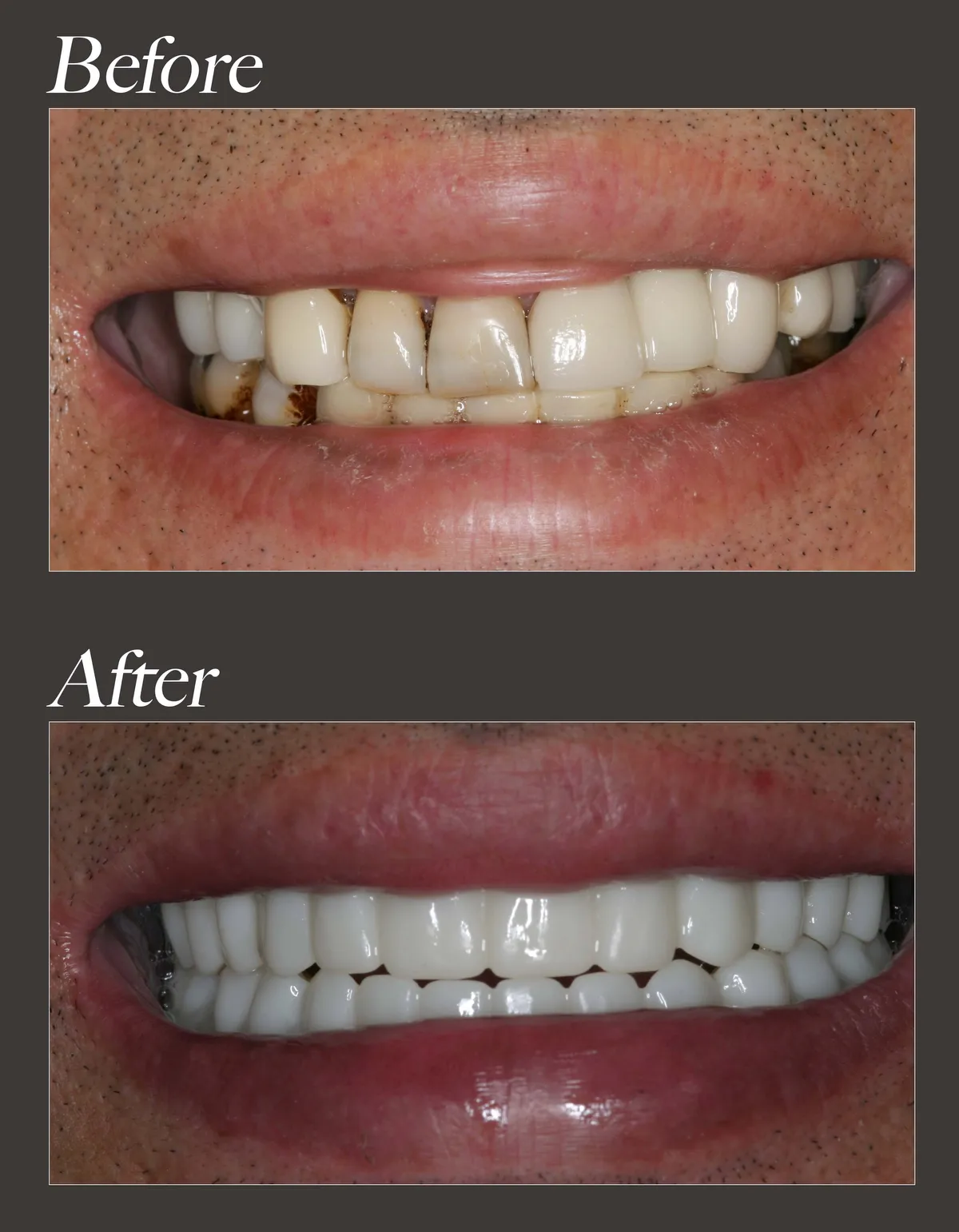 All-on-6 dental implant before and after case 3