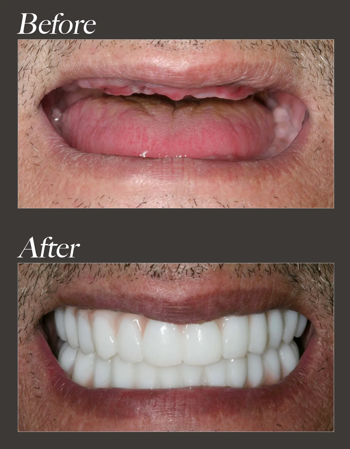 Dental implant before and after case 1