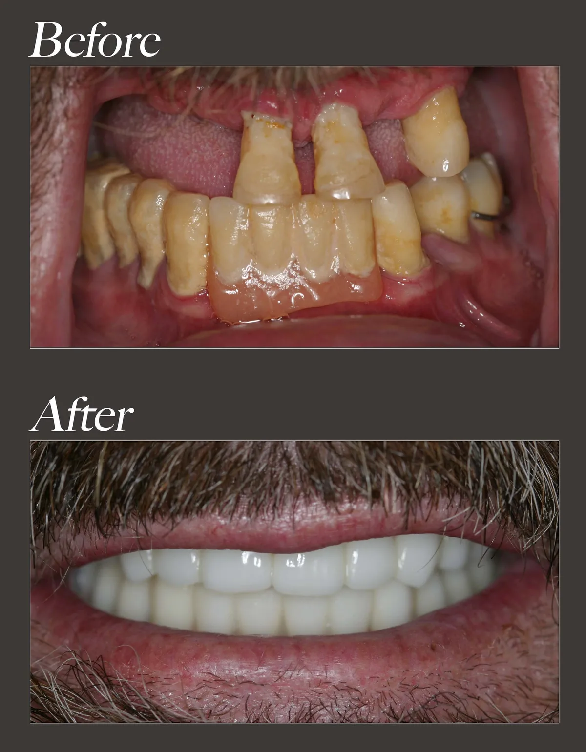 Dental implant before and after case 2