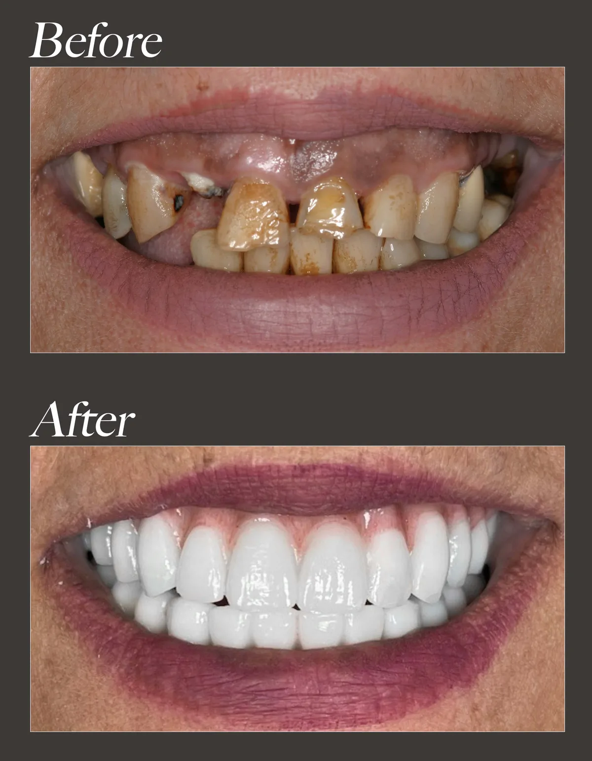 Dental implant before and after case 3