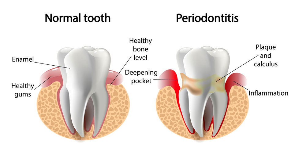 Gum Disease Infographic