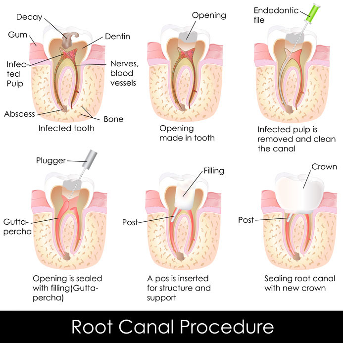 Root Canal Procedure